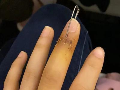 女子下楼扔垃圾，竟扔出个手指！一看，还是自己的……