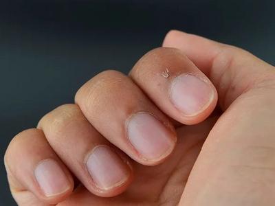疼疼疼！倒刺撕到停不下来真不是缺维生素，而是因为这个习惯……