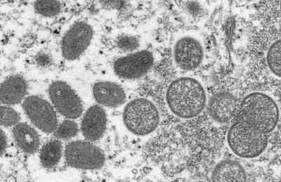 世界卫生组织：多国发现猴痘病例属于“非典型”情况