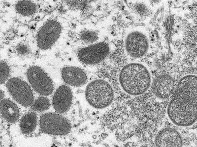 美国确认今年首例猴痘死亡病例，已累计报告22630例确诊病例