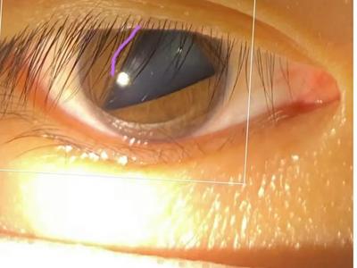 瞳孔突然变成三角形，是新冠后遗症？真相是……