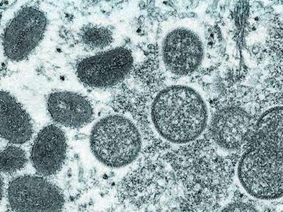 国家卫健委：9月20日起将猴痘纳入乙类传染病进行管理