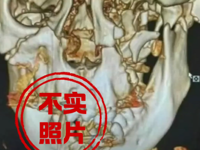 网传邯郸初中生遇害案颅骨照片不实