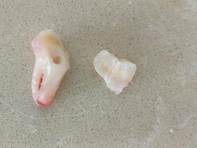 坏了一颗牙，竟一次被拔29颗牙！老年人口腔治疗乱象调查