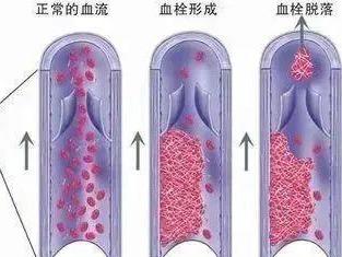 险些截肢，接连10余人确诊！这个习惯很多人都有→