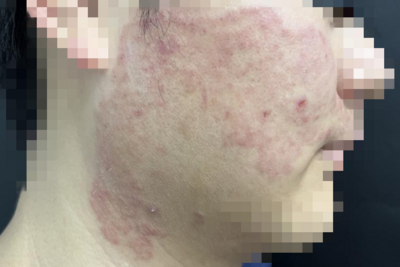 一次失误，27岁帅小伙差点毁容，惨不忍睹！医生：可传染全家