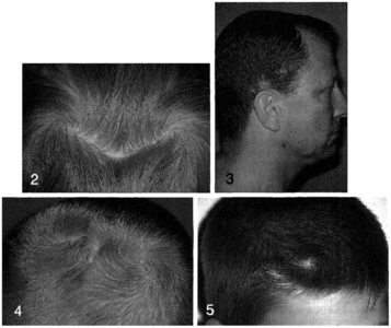 为什么每个人的头发都有“旋”？“两个旋”真的更聪明？