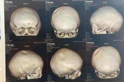 心疼！8岁小孩遭醉汉用椅子砸头，“要做开颅手术”
