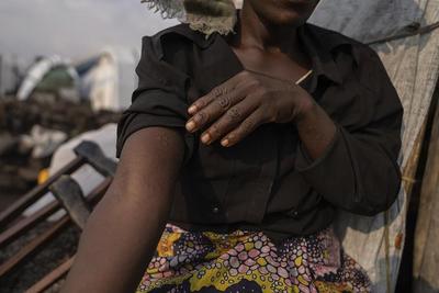 非洲多国出现猴痘疫情并发现变异毒株