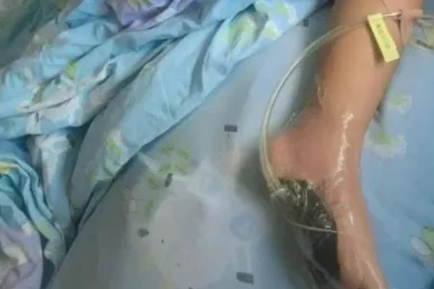 6岁男童沙滩光脚踩到死鱼后高烧进ICU，医生提醒