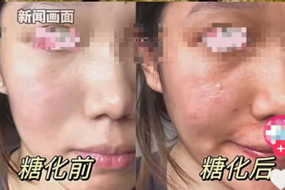 奶皮子糖葫芦爆火有人吃出“糖化脸”，医生提醒→