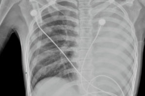 发热仅1天，肺全白了！这种病极度危险，千万别当普通感冒