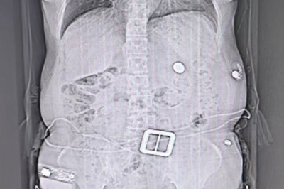 大年初一，68岁老人吃饺子突然呛咳、胸闷难忍，元凶竟是……