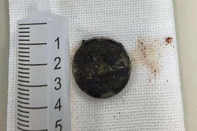 纽扣电池、花生米……青岛专家提醒：这些异物都曾伤害过孩子的鼻腔