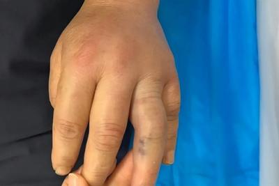 青岛八医与“12345”极速联动，为被蝮蛇咬伤老人抢出生命通道